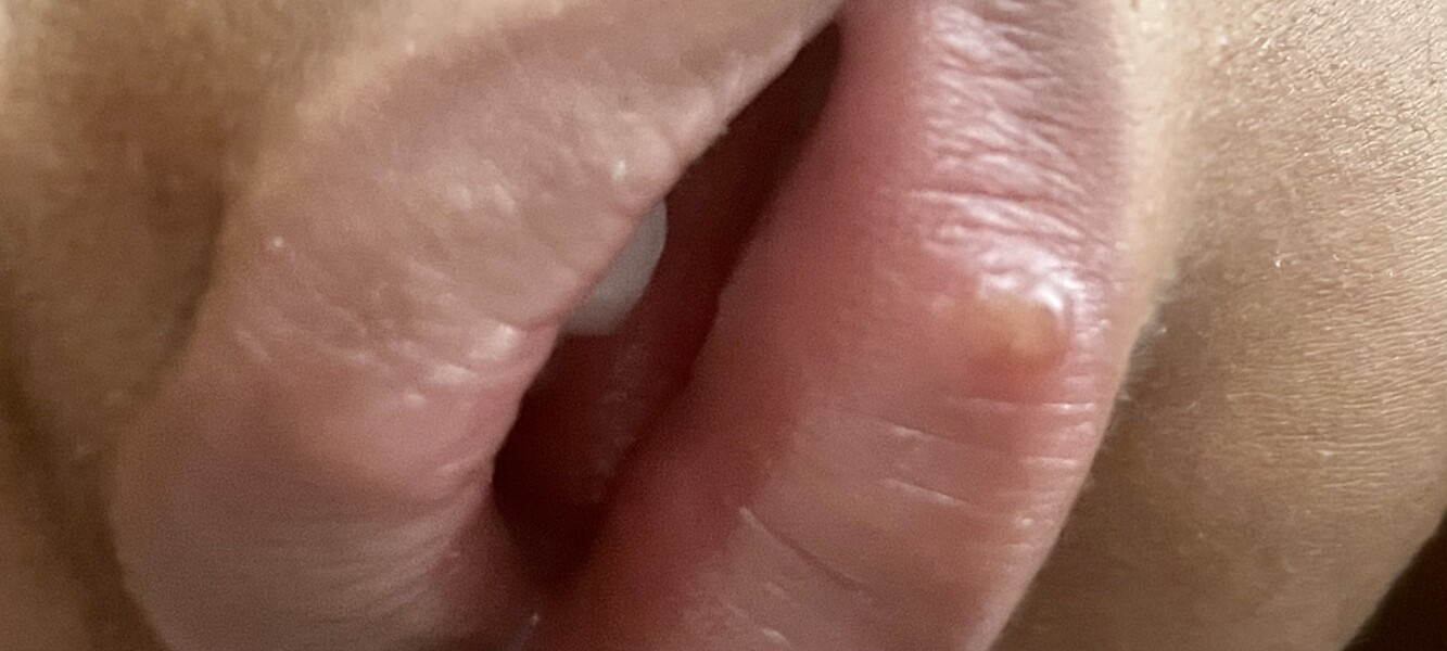Is this a cold sore?