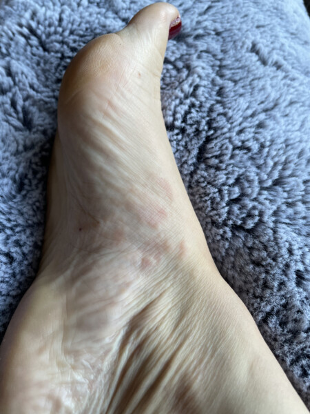 Seriously suffering with pompholyx/ dyshydrotic eczema - any tips
