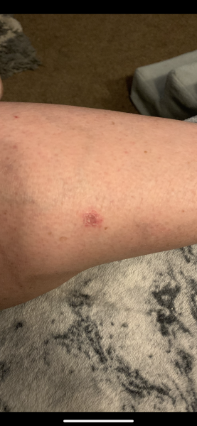 Mole or melanoma?