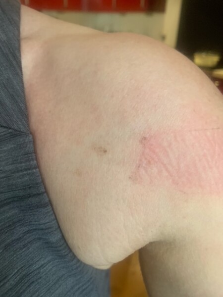 Please help! New moles (skin) that appear and disappear over night - worried!! 