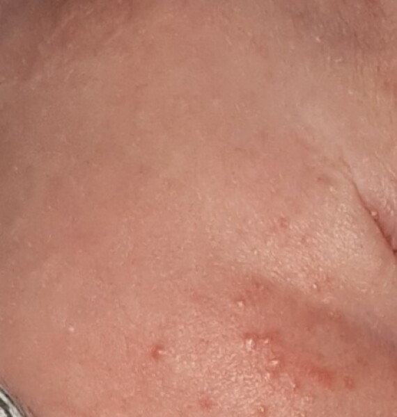 Baby acne?