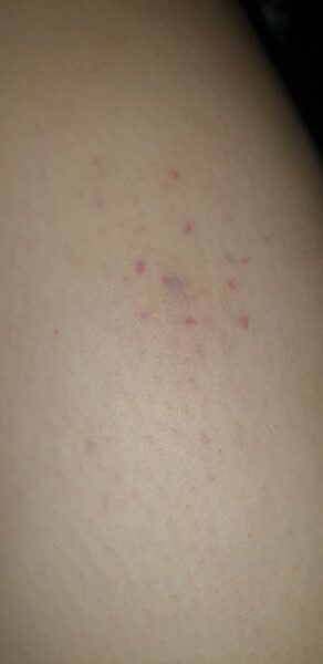 What would cause these small purple marks above my knee? (Pic)