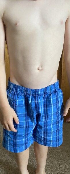 Swollen abdomen 