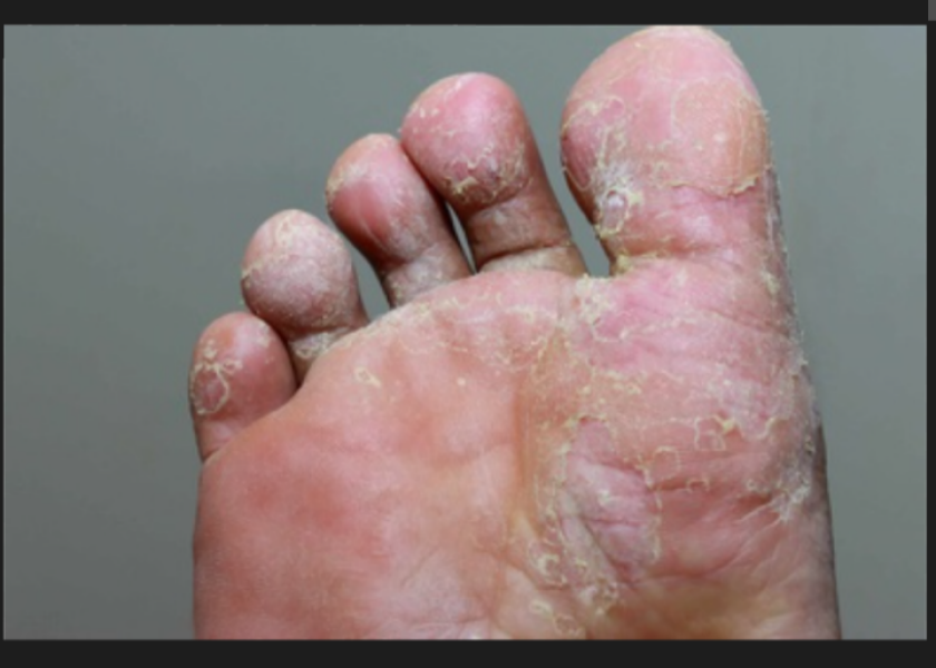 To think I have diabetic feet. Gross picture included. 