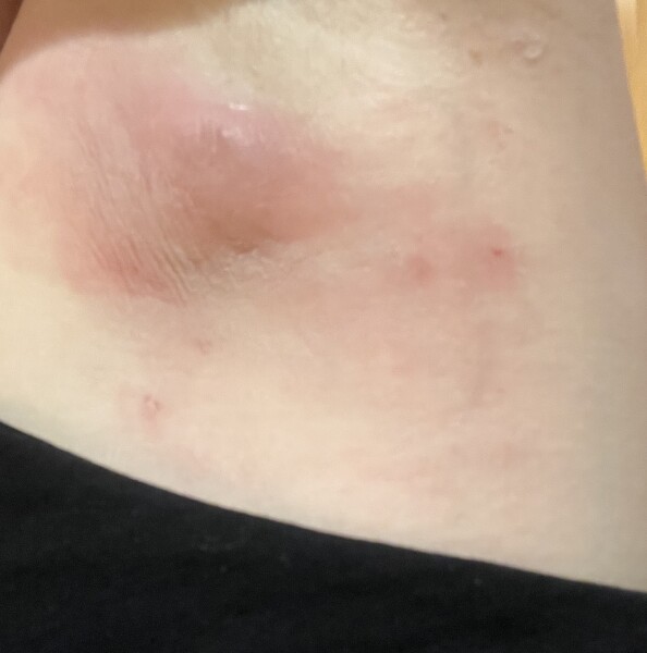 Is this a boil?! Help! 