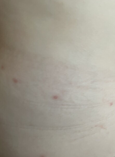Feeling conflicted about whether this is chickenpox!?