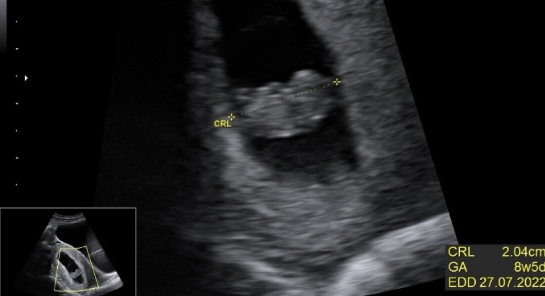8 weeks on Monday and booked a scan