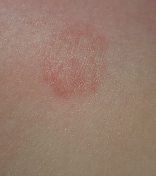 Mark on my breast (pics included)