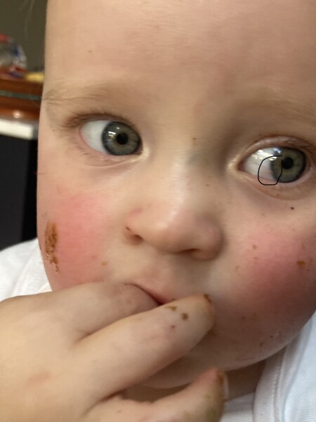 Red spot on toddler eyeball 