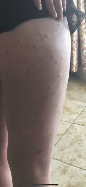Mosquito bites driving me to insanity! Send help!
