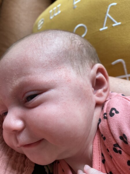 Baby rash