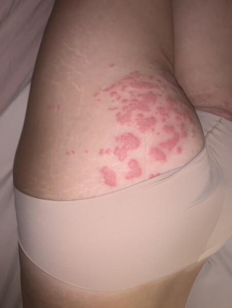 What is this rash? Pic