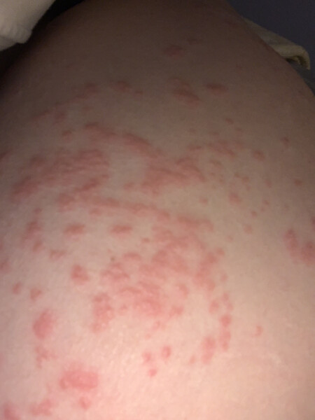 What is this rash? Pic