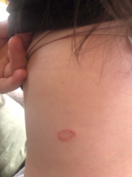 16 year old ring rash?