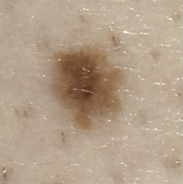 Does this look like melanoma? 