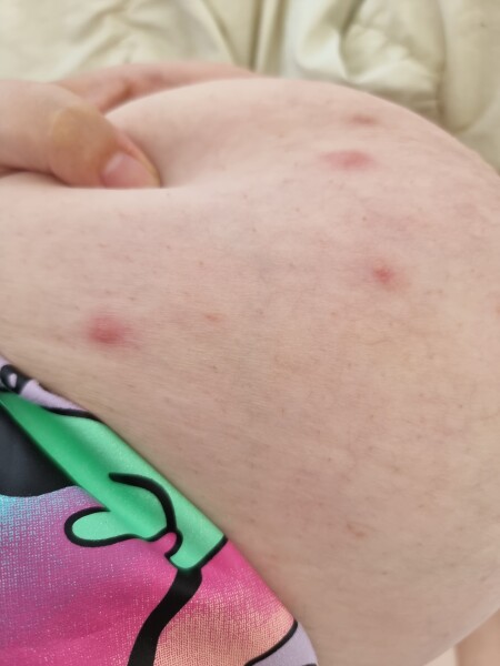 I keep getting these on my breaststroke, what are they? Why? (Tw gross pic)