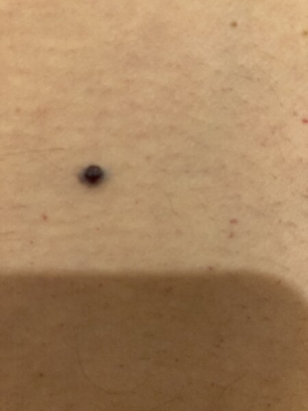 Slightly concerned about this mole