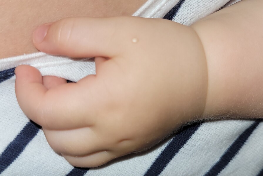 White spot on baby hand