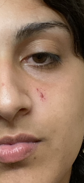 Anyone know how to treat a scab like this? - minimise scarring?