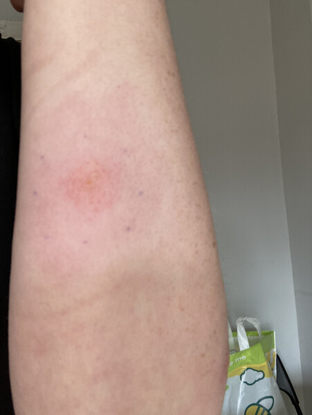 What has bitten me?!