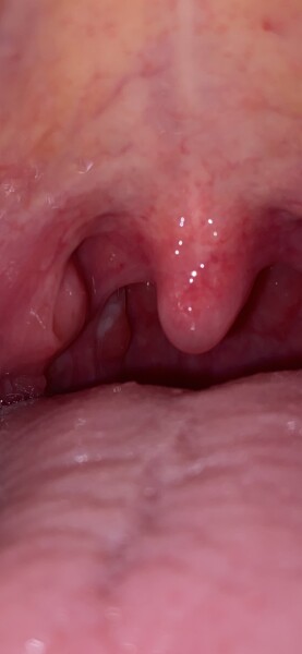 Tonsillitis? PIC ATTACHED