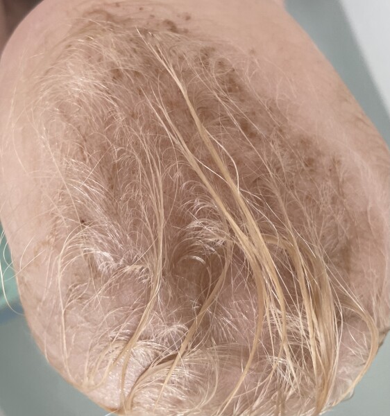 Dark patches on baby’s scalp?