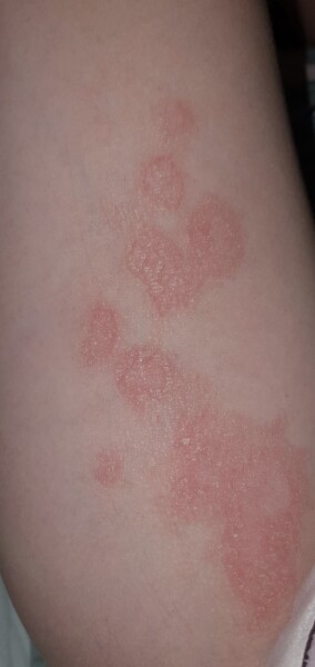 Ringworm