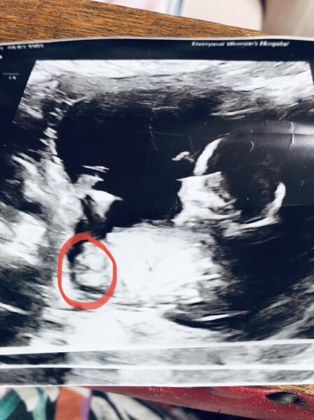 Is this a girl nub?