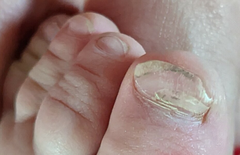Can anyone tell me whats going on with my child's toe? 