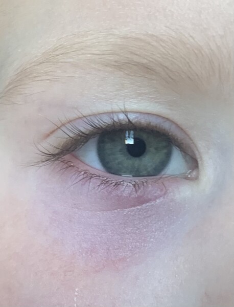 What’s up with DD’s eye? 
