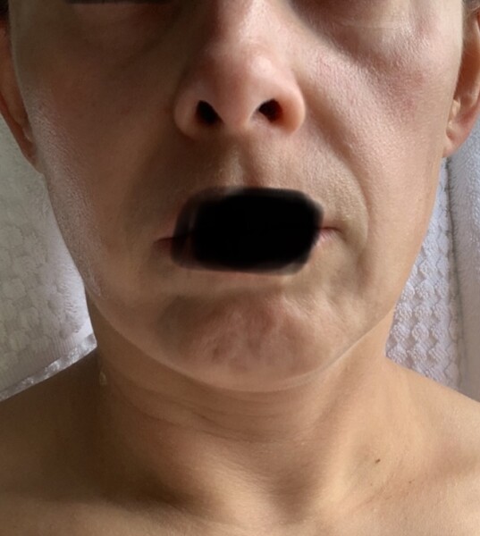 Sagging face and 45. What would you recommend? (Unflattering anonymised photo attached!)