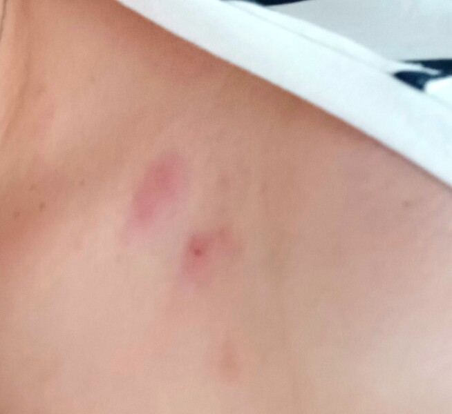 What kind of bite is this?