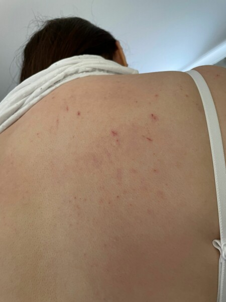 Shingles