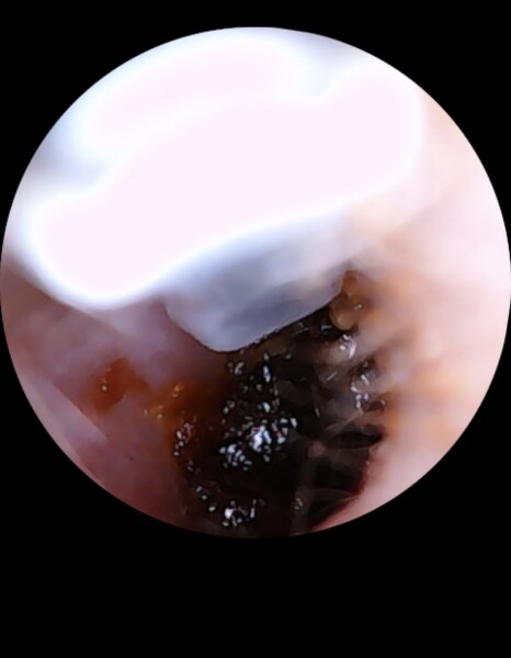 Help spornererers- ear wax! 
