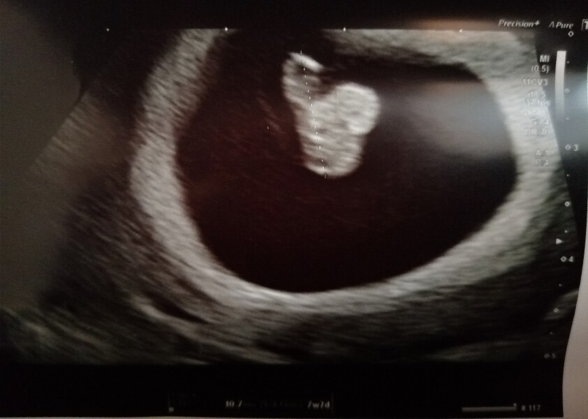 TTC immediately after miscarriage 