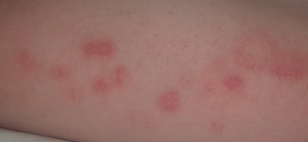 Ringworm