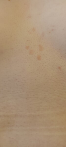 What are these blotches multiplying on me...