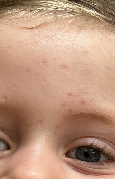 Severe chicken pox help!