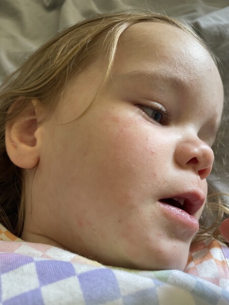Chicken pox? 