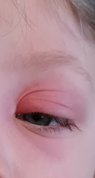 Does this look like periorbital cellulitis? 