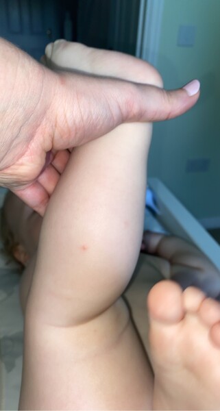 Urgent - is this chickenpox? 