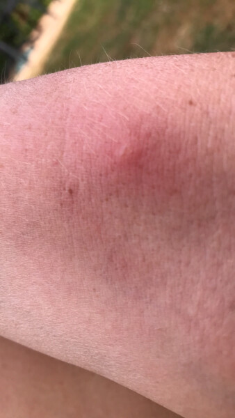 Photo of my pallid, stubbly leg for your delectation - would you be concerned about these bites?