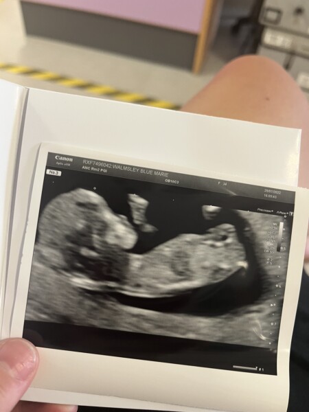 12 week scan