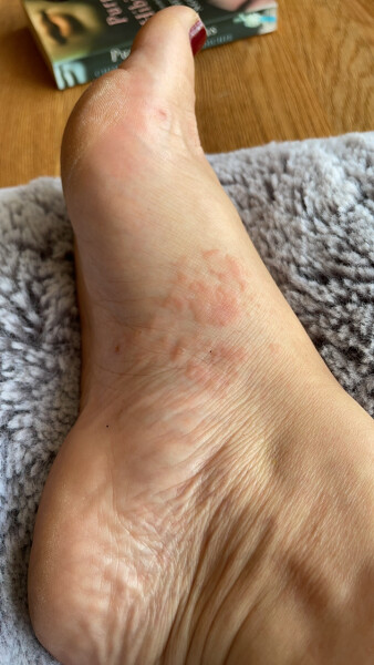 Seriously suffering with pompholyx/ dyshydrotic eczema - any tips