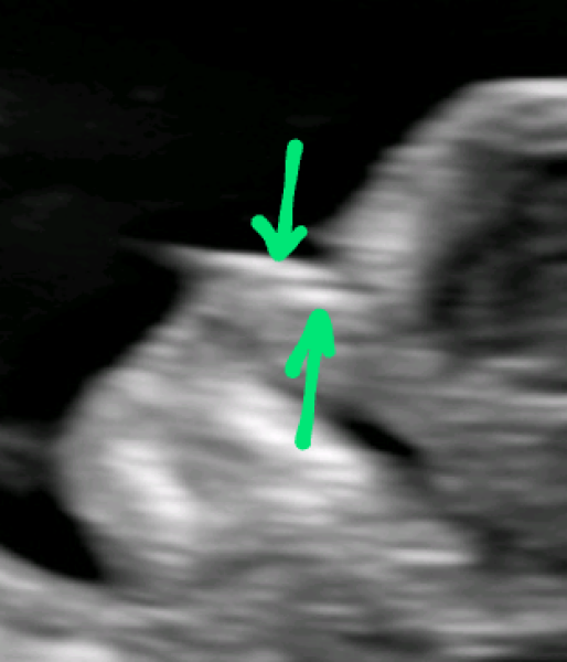 Nasal bone