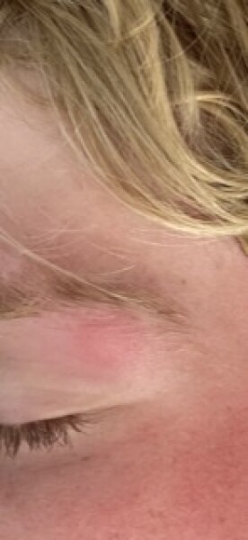 Monkey pox or mosquito bites?!