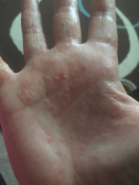 Seriously suffering with pompholyx/ dyshydrotic eczema - any tips