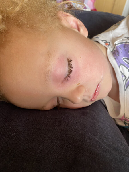Does this look like periorbital cellulitis? 