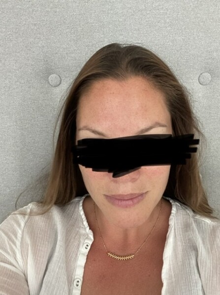 Receding hairline - to fringe or not to fringe 