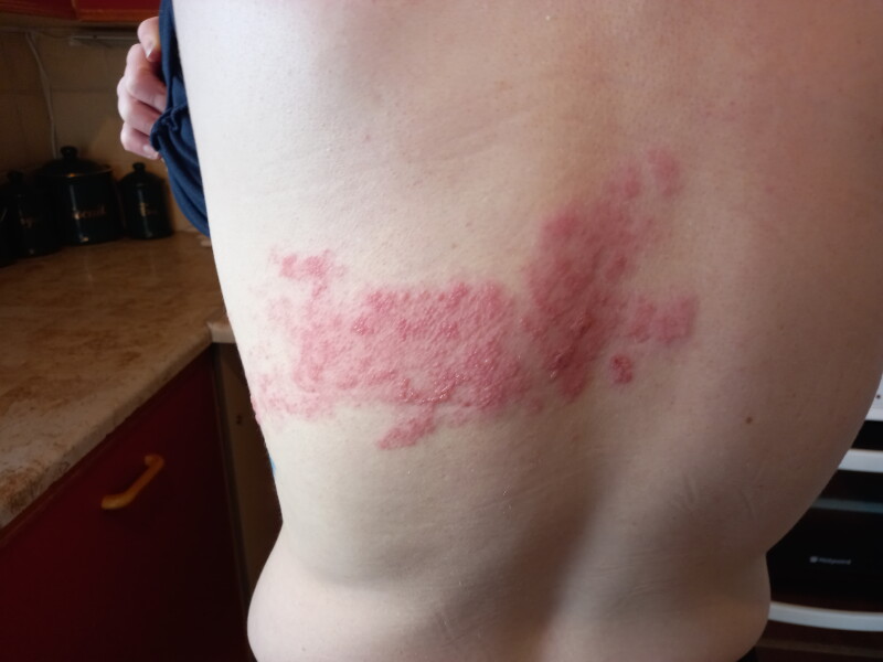 Recurring shingles - anyone had a similar experience??